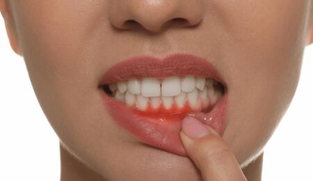 عفونت لثه چیست و چگونه درمان میشود؟ عفونت لثه چیست و چگونه درمان میشود؟