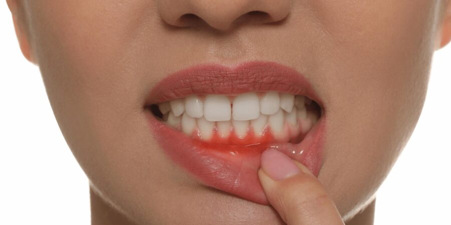 عفونت لثه چیست و چگونه درمان می‌شود؟