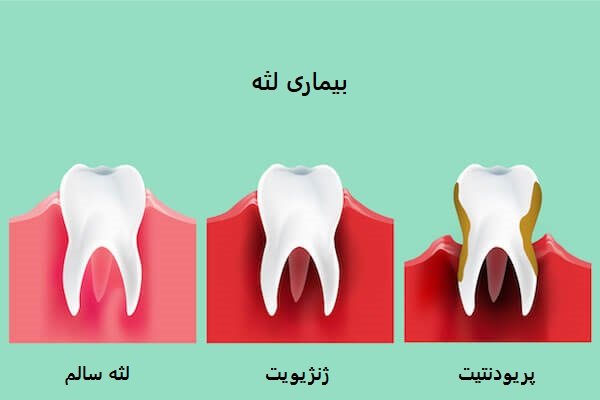 تفاوت ژنژیویت و پریودنتیت