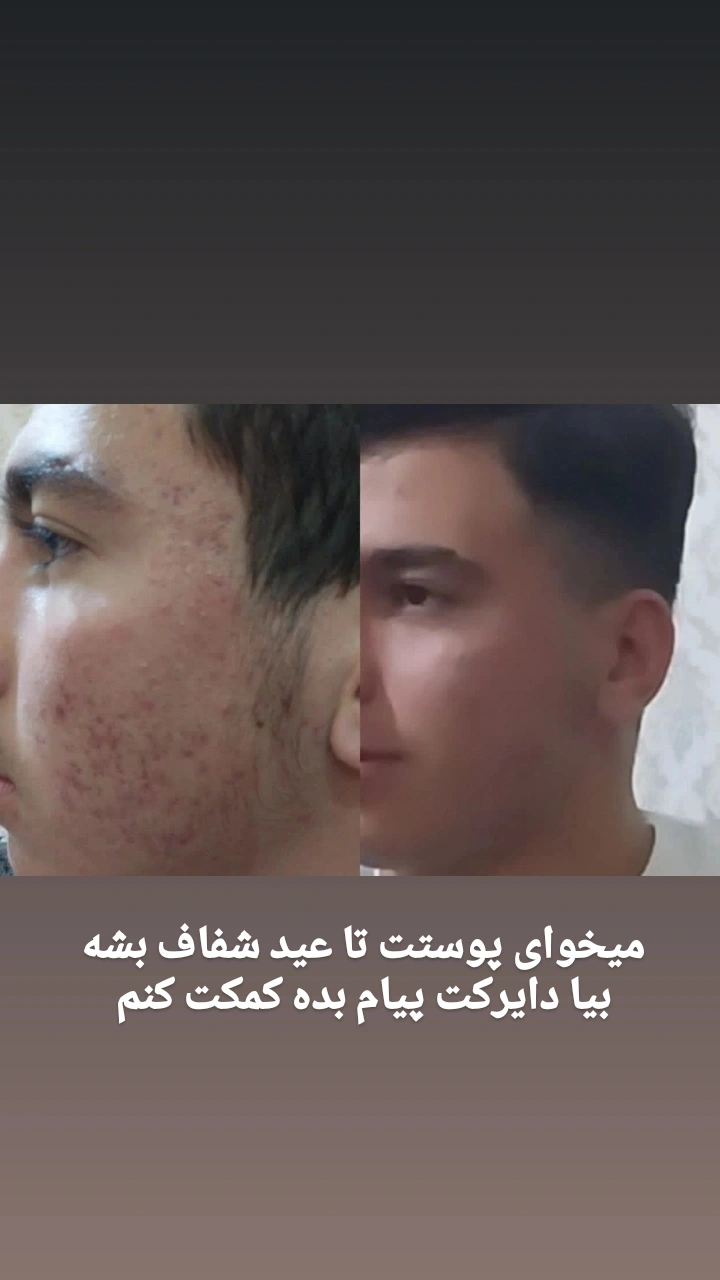 پوست زیبا بدون لک و جوش