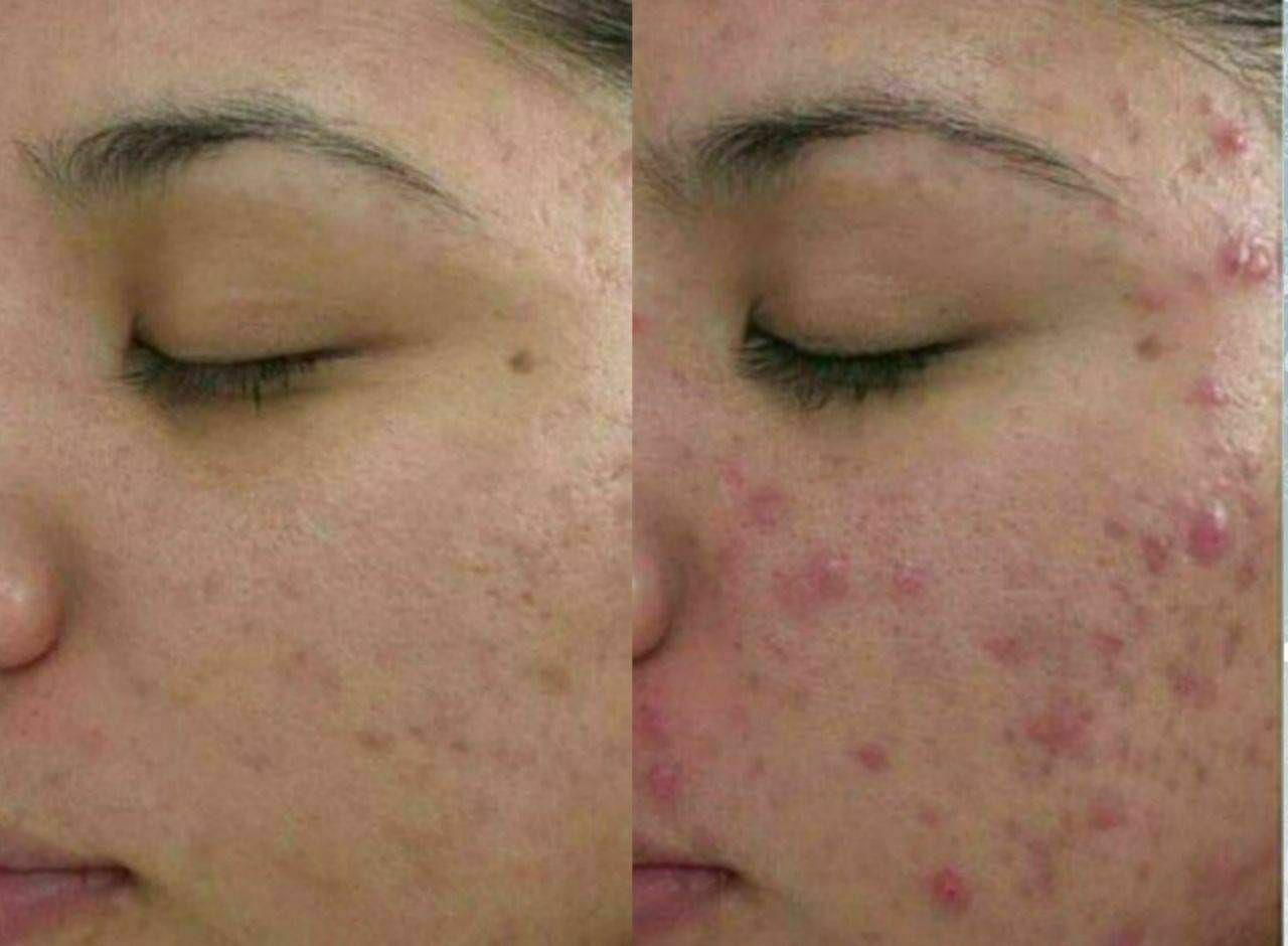 پوست زیبا بدون لک و جوش