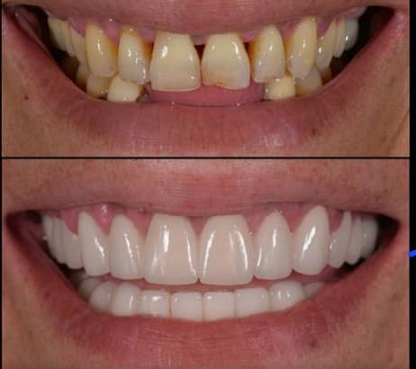 کامپوزیت و لمینت بدون