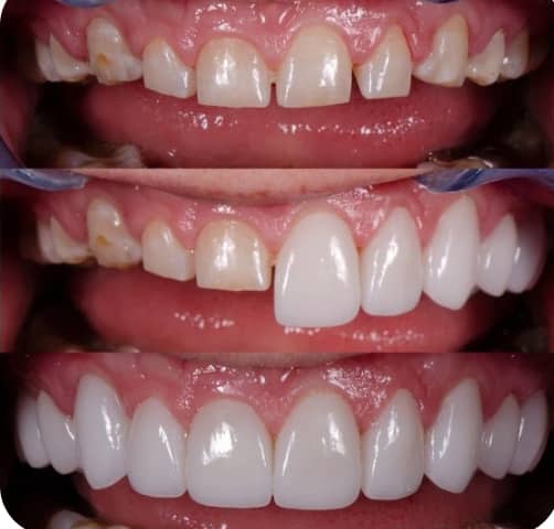 کامپوزیت و لمینت بدون