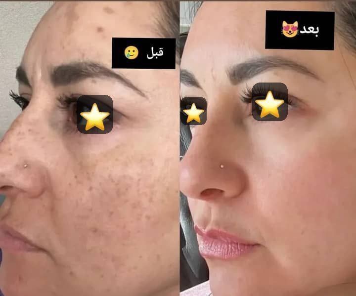 بهبود لک های کبدی ، ملاسما ، افتاب سوختگی و جای جوش