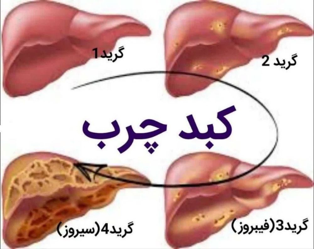 کبد چرب