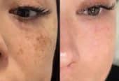 ضدلک صورت روشن کنده صورت