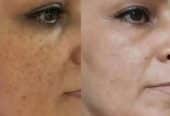 ضدلک صورت روشن کنده صورت