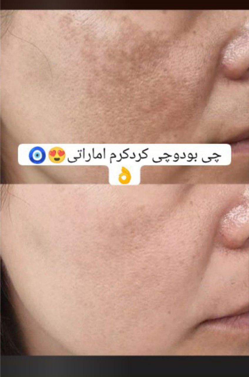 فرمول کرم سفید کننده معجزه
